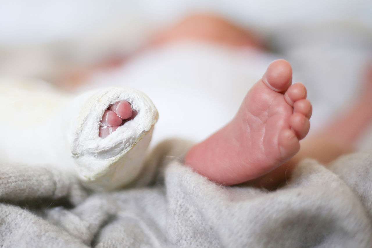 Closeup of newborn little baby with leg in a cast - clubfoot